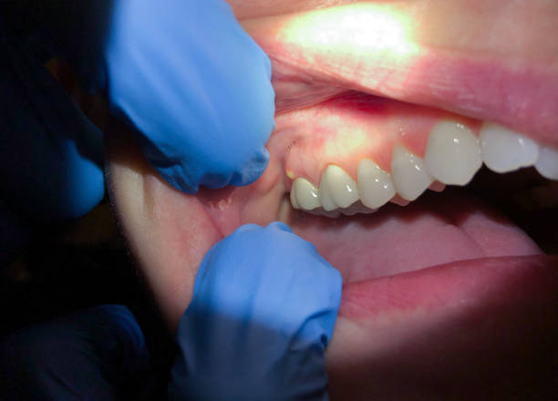 Best Broken Tooth Emergency  in Thornport, OH